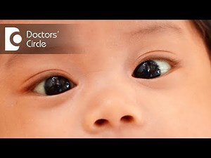 Causes of squint - Dr. Sirish Nelivigi
