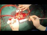 Parachute Mitral Valve Replacement in an Adult  from LA Access • Video • MEDtube.net