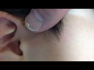 Preauricular ear pit