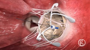 Transcatheter Mitral Valve Replacement | Caisson Intervention
