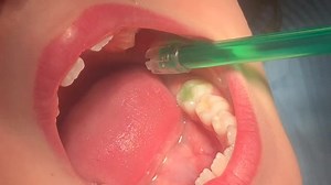 Are they for children or adults? I was asked by many what exactly is a Fissure sealant again? Are they for children or adults ? So here is a video from our surgery with a very simple explanation As quoted on Google 👍 Fissure sealants are a safe and painless way of protecting your children's teeth from tooth decay. It is a plastic coating which covers the chewing surfaces of the back adult teeth. The sealant forms a rigid shield that keeps food and bacteria from getting into the teeth' tiny groo