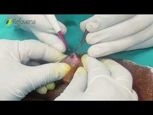 Live Laser Frenuloplasty Surgery in Jaipur | Dr Deepesh Goyal | Rejuvena Cosmo Care | Cosmetic