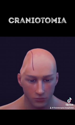 Understanding Craniotomia and Craniectomy Surgery