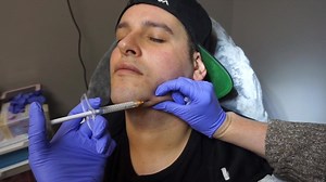 Male Jawline Enhancement and Kybella treatment
