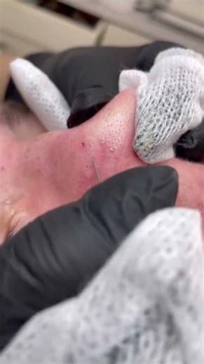 Professional Nose Pore Cleanup — Satisfying Squeezes! 💆‍♂️✨