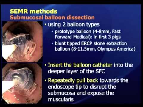 Submucosal Endoscopy With Mucosal Resection (Semr): A New Hybrid Technique Of Endoscopic Submucosal