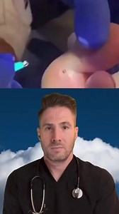 Very large splinter extraction from the foot. #splinterremoval #cystpopping #pimplepopper #abscess | Mary Johnson