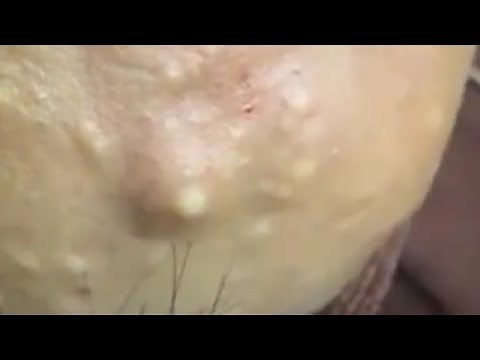 LARGE Blackheads Removal - Satisfying Blackhead 2019