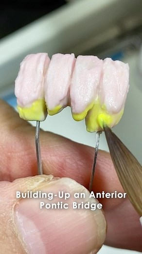 21K views · 4 comments | Building-Up an Anterior Pontic Bridge! Join our YouTube Membership or Patreon to see more! YouTube.com/LSK121 Patreon.com/LukeKahng #reel #reels #dental #dentist #dentaltech #dentaltechnician #dentaltechnicians #buildup #anterior #pontic #bridge #implant #implants #zirconia #youtube #youtubemembership #patreon #patron #video #lukekahng | CEO Luke Kahng | Facebook