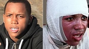 Viral ‘Hot water challenge’ leaves teen seriously burned 'My skin just fell off my chest and face'