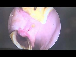 Using State of the Art Techniques to Extract Trapped Teeth in Horses