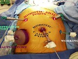 Robotic Transhiatal Esophagectomy • Video • MEDtube.net