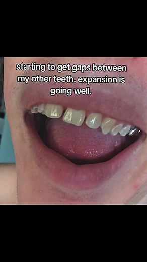 Effective Teeth Expansion with Headgear Braces