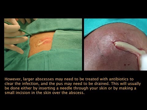 Abscess PEV