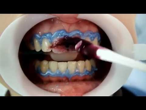 Using FGM Whiteness HP Maxx For In Office Bleaching Tooth Whitening