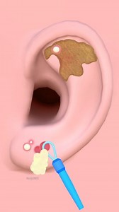 pimples at the earring site or dirt on the ear that needs to be removed Cleaning Satisfaction #asmr #earcleaning #satisfying #reelsvideoシ #animation Tunnig ASMR | Tunnig ASMR