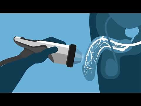 Shockwave Therapy for Erectile Dysfunction - How Does it Work?
