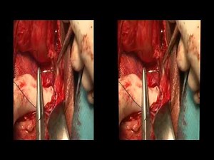 3D Total pelvic floor repair