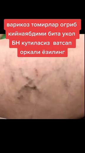 Removing a Splinter from a Wound: Step-by-Step Guide