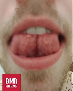 12 reactions | Sample of a tongue split into healing. #tongue #tonguesplit #splittongue #bodymod #bodymods #instabodymod #bodymodification #aipp_pierceritaliani #safepiercing #brunobma #ghirigorifamily #piercinglecco #piercingsondrio #piercingcomo #piercingmonza #piercingmilano #piercingroma | Bruno BMA | Facebook