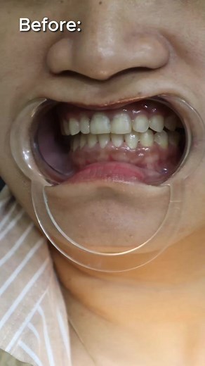 22K views · 351 reactions | Instant celebrity smile! 李 #DrRFD #DrRFDSmile #DrRFDMakeItHappen #urbansmilesdentalclinic #WhereBeautifulSmilesAreMade #smilemakeover #smiletransformation | Dr.RFD | Facebook