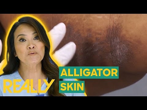 Dr. Lee Treats Patient With 'Alligator' Skin | Dr. Pimple Popper: Pop Ups