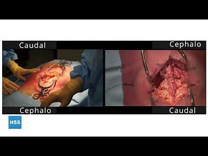 For Surgical First Assist: Posterior Lumbar Laminectomy and Fusion (Cadaveric)