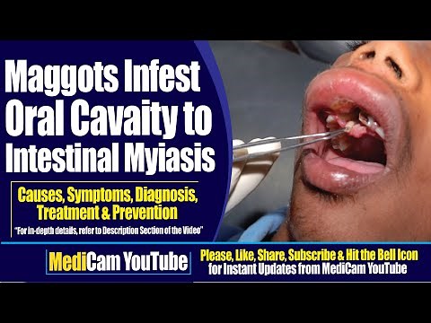 Maggots Infest Oral Cavity to Intestinal Myiasis | Medicam
