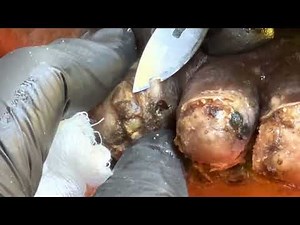 Julius right foot - see this full video and 1000s of jigger videos @riseupsociety.net