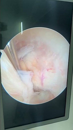 ACL ganglion cyst-keyhole surgery (arthroscopic decompression) #kneearthroscopy #acl #ganglioncyst
