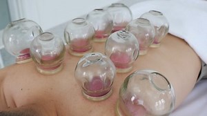 Chinese Traditional Treatment Medical Cupping Therapy: стоковое видео (без лицензионных платежей), 1036854722 | Shutterstock