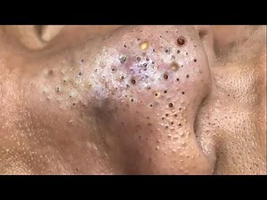 Big Cystic Acne Blackheads Extraction Blackheads & Milia, Whiteheads Removal Pimple Popping # 3364