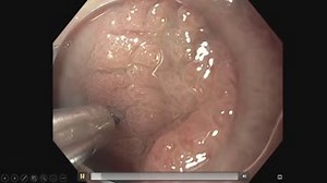 David M. Poppers, MD, FASGE, AGAF discusses Endoscopic Mucosal Resection in this week's video tip. See the full video and more video tips online. http://ow.ly/B7si50BGRGS #ASGE #GITwitter #GIEndoscopy #GITwitter #gastroenterology #endoscopy | American Society for Gastrointestinal Endoscopy - ASGE