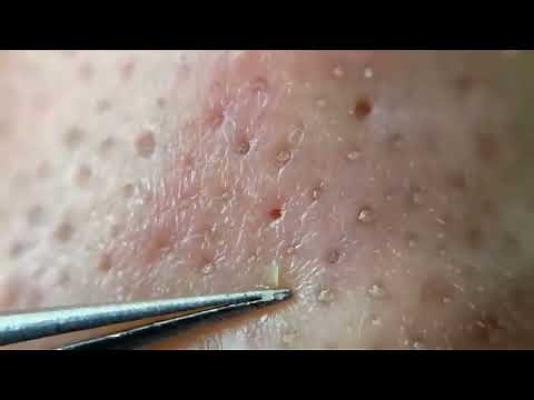 Blackhead Removal With Tweezer (30 Minutes)