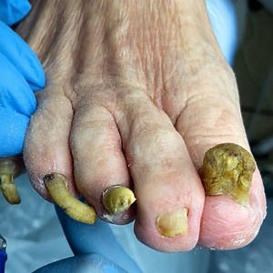 Thick toenail treatment! | MetDaan