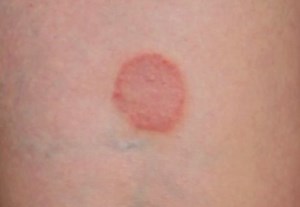 Ringworm: Images, Causes, Symptoms, Treatment