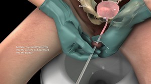 Male Self Catheterization Procedure - R31379-06X