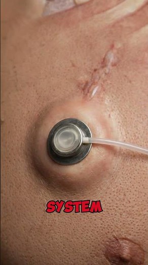 Portkatheter: Die unsichtbare Hilfe bei der Chemotherapie!