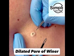 Dilated Pore of Winer Extraction