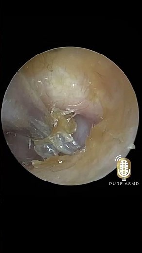 Deep Earwax Extraction | Wax Off Episode 72 Plug Reveal