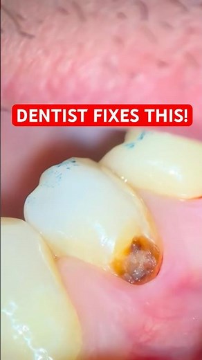Watch This Tooth Transform! Class V Composite Restoration Under Rubber Dam