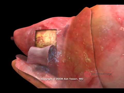 Prostate 3d Medical Animation Medical Visualization