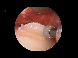 Forehead osteoma with Prof Richard Harvey