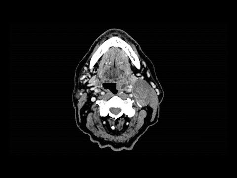 Radical Tonsillectomy for HPV+ Oropharyngeal Cancer