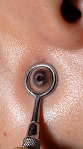 Extreme macro close up of a blackhead suction device pulling out blackheads in real time | ThyA