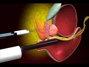 Prostate Cancer Cryotherapy