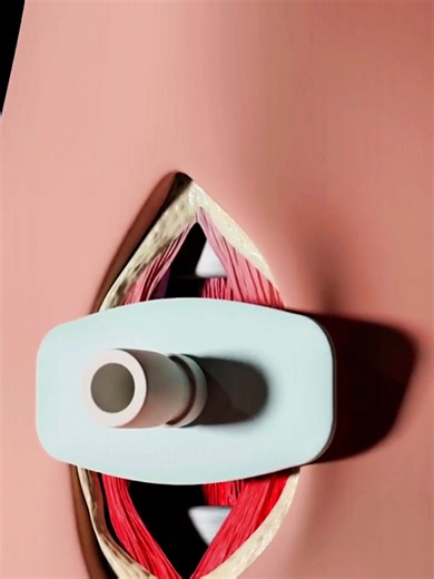 How Tracheotomy Surgery is Performed? (3D Animation) #how #tracheostomy #surgery #lifesaving #3danimation