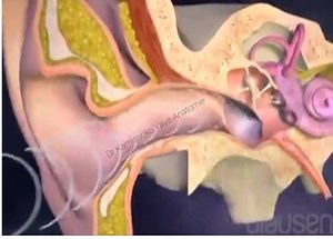 Implants cochléaires Lorsque les ondes sonores parviennent à l'oreille, elles sont concentrées par l'oreille externe qui a une forme d'entonnoir et transmises vers l'oreille moyenne. Lorsque le son passe dans l'oreille moyenne, les ondes sonores frappent le tympan. Les vibrations traversent ensuite l'oreille moyenne et atteignent l'oreille interne remplie de liquide. L'oreille interne contient une structure importante appelée la cochlée. À l'intérieur de la cochlée, les vibrations sonores déplac