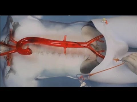 REBOA: Resuscitative Endovascular Balloon Occlusion of the Aorta