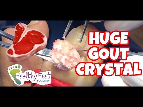 Removing Gout Crystals & How to Prevent Gout